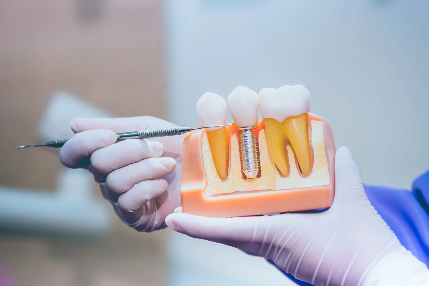 Jak wygląda zabieg wszczepiania implantów zębowych?