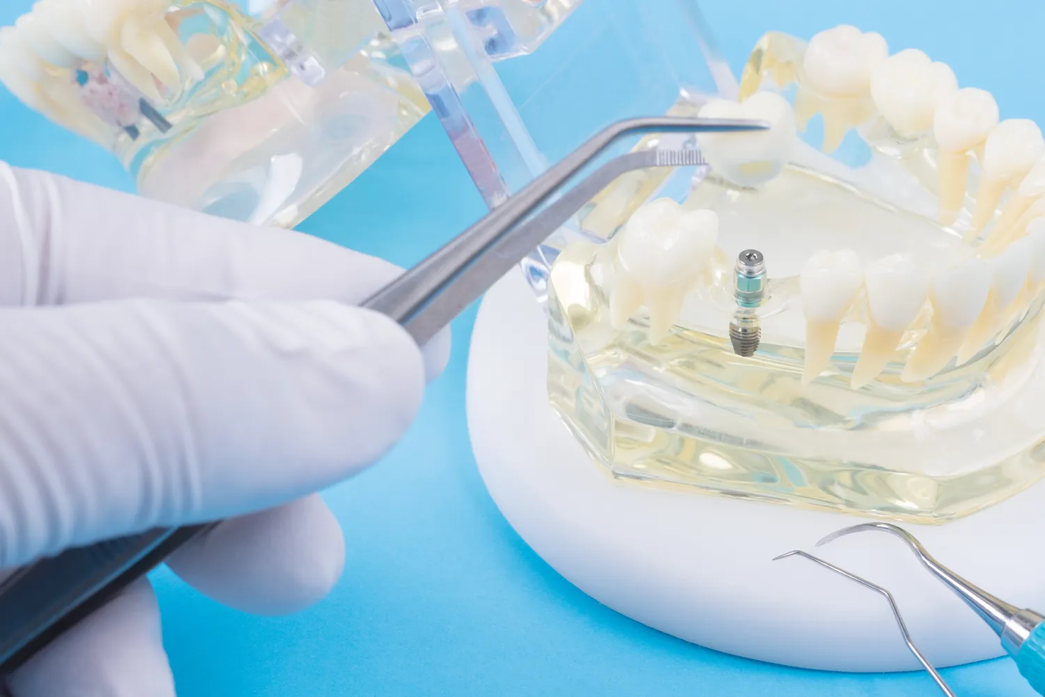 Implanty w jeden dzień Kołobrzeg