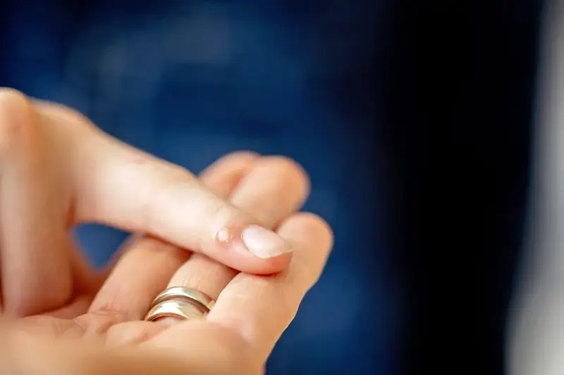 Jaskółcze ziele na kurzajki jak zrobić?